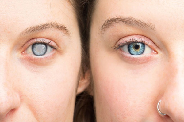 Cataracts Form